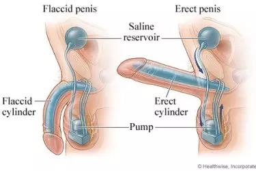 Penile Implant Surgery in India, Best Doctor for Penile Implant Surgery in India, Best Hospital for Penile Implant Surgery in India, Cost of Penile Implant Surgery in India, best doctor for penile prosthesis surgery in india, best doctor for 3 piece penile implant in india, best doctor for 2 piece penile implant in india, best doctor for malleable penile implant in india, best hospital 2 / 3 piece penile implant in india, cost of 3 piece penile implant in india, cost of 2 piece penile implant in india, cost of malleable penile implant in india